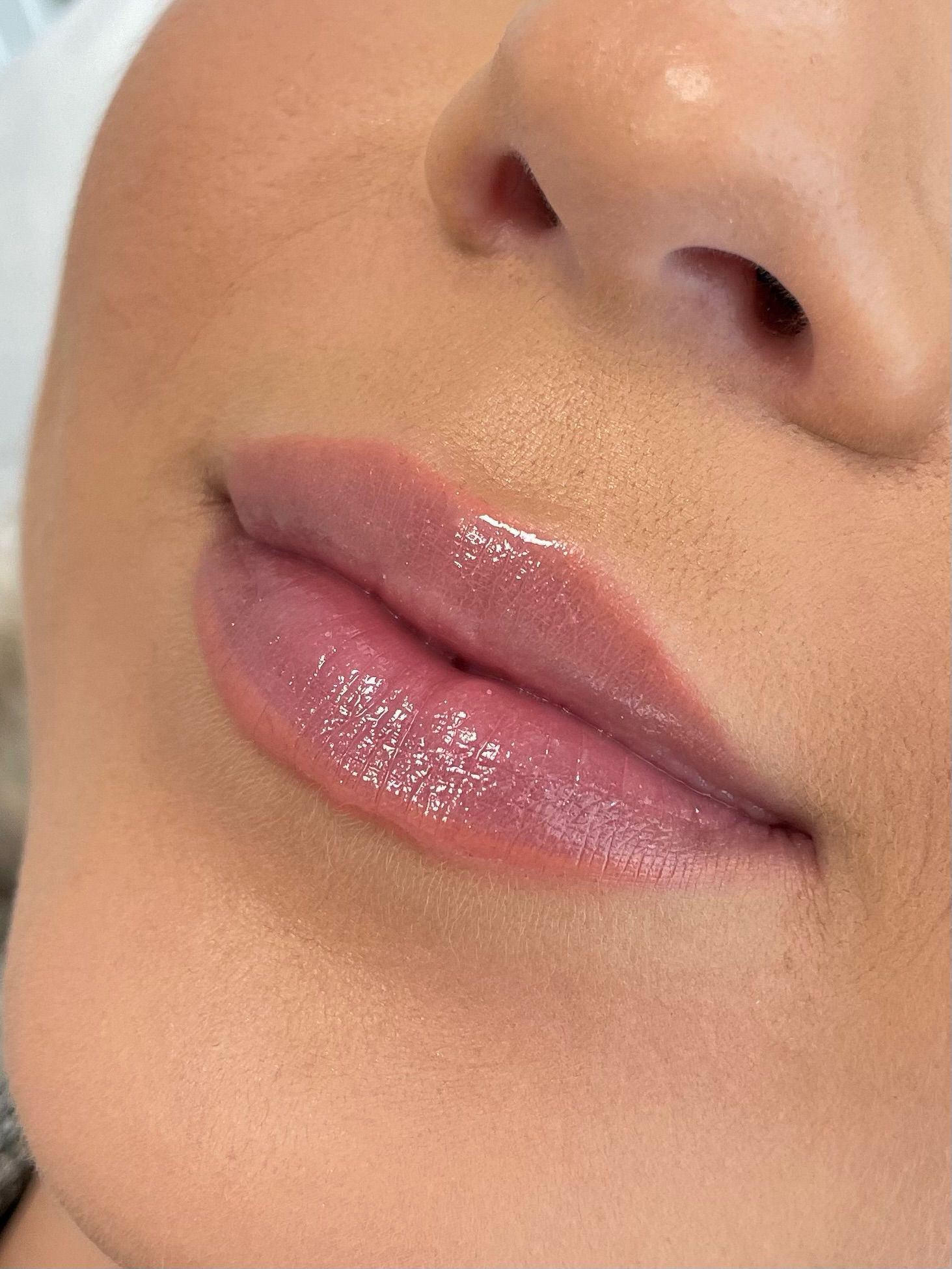 What Happens During a Lip Filler Treatment? Step-by-Step Guide