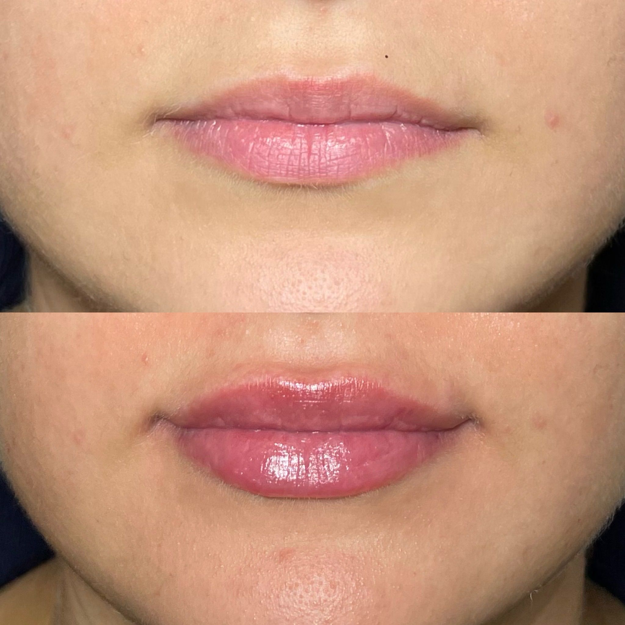 The Rise of Hyaluronic Acid Lip Fillers: What’s the Buzz?