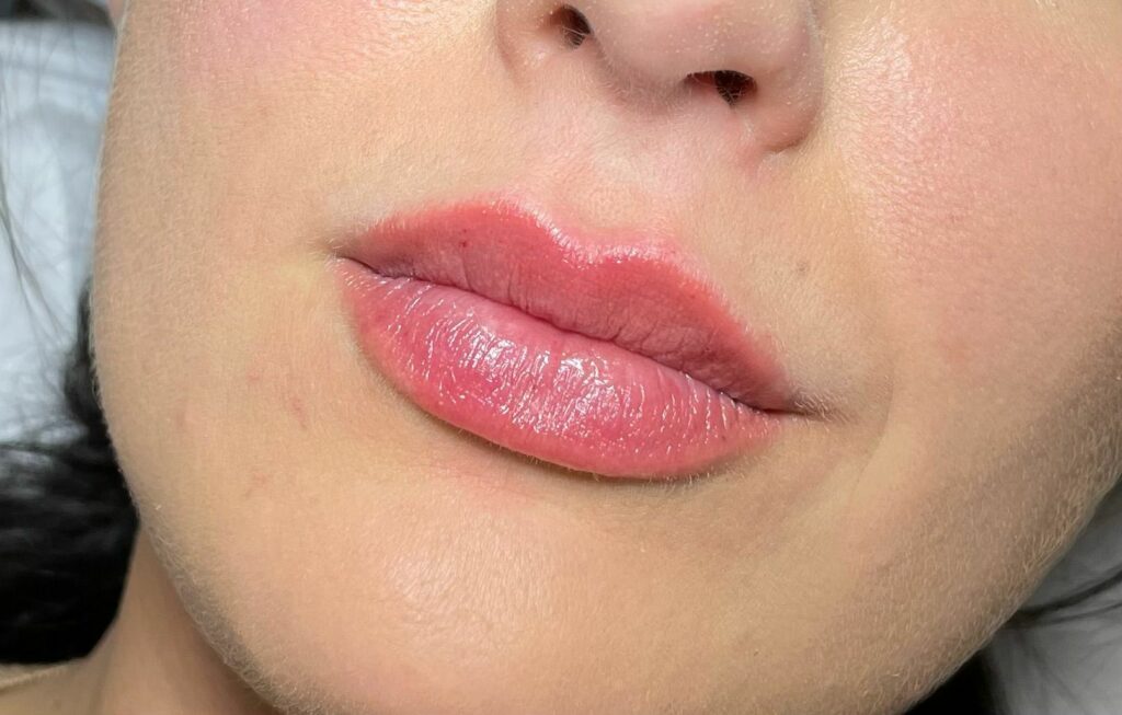 How Long Do Lip Fillers Last? A UK Guide to Longevity