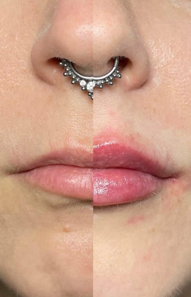 What Are the Risks of Lip Fillers and How Can You Avoid Them?