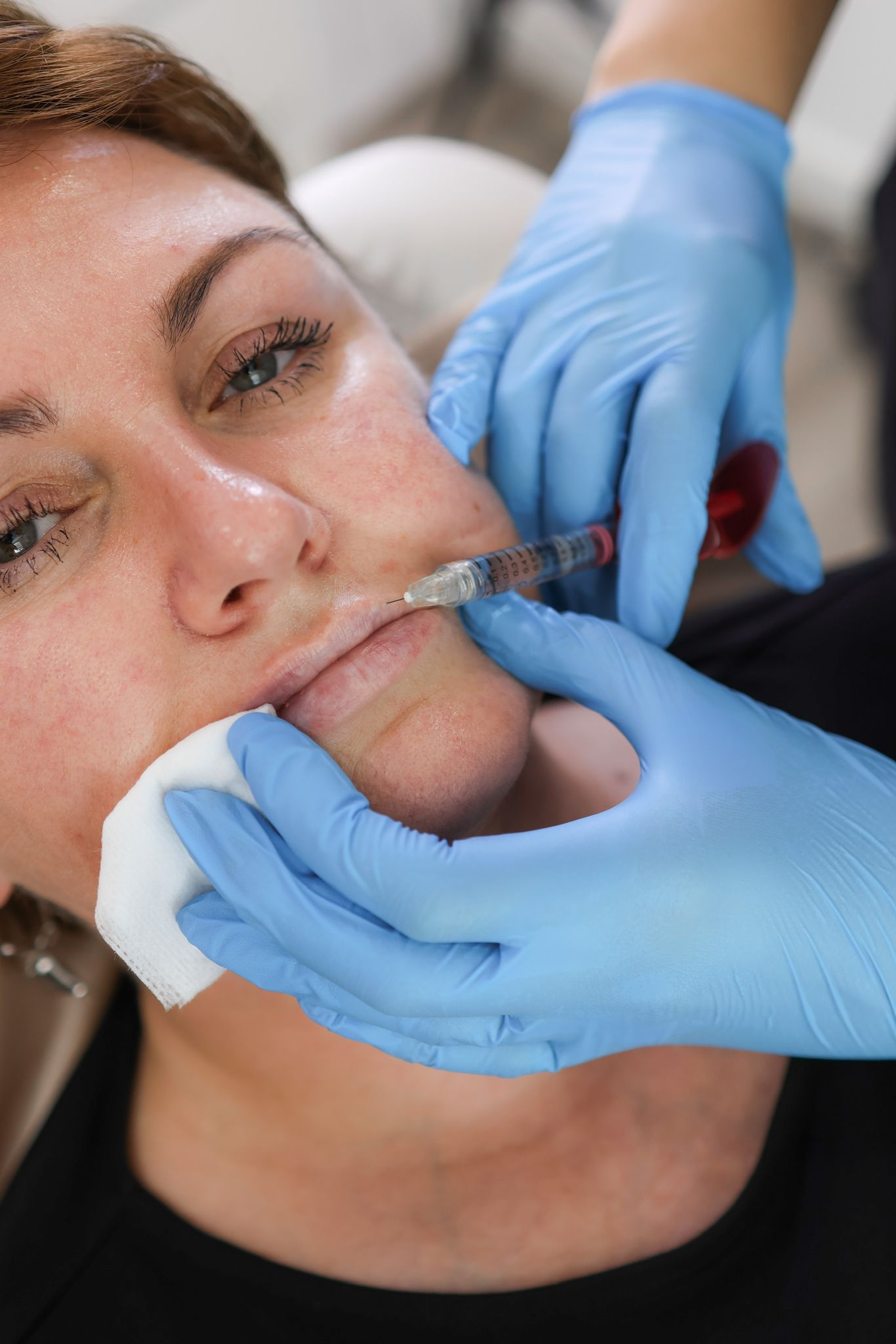 Everything You Need to Know About Non-Surgical Lip Enhancement