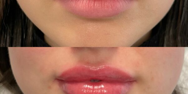 Lip Filler London - Natural Lip Enhancement & Lip Augmentation