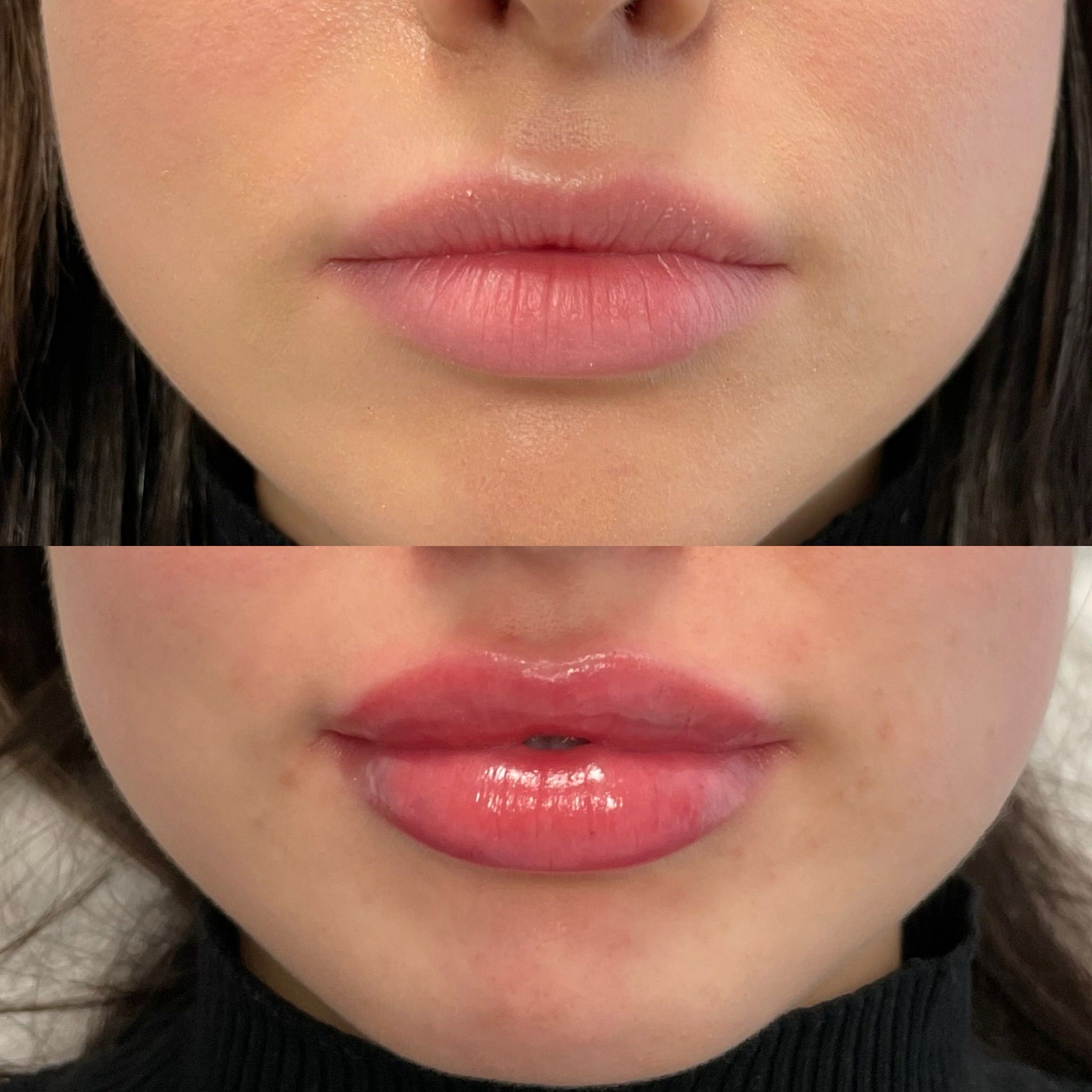 Lip Filler London - Natural Lip Enhancement & Lip Augmentation